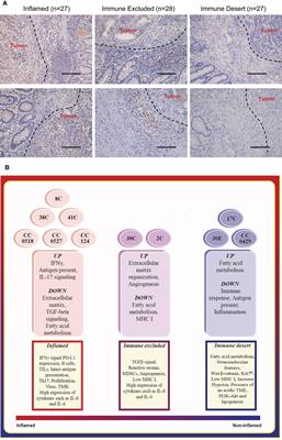 Immune desert in MMR-deficient tumors predicts poor responsiveness of immune checkpoint inhibition